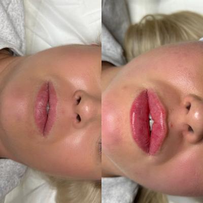 reluma kiss before after.jpg